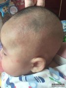如何预防宝宝的湿疹？婴儿的湿疹应该如何预防