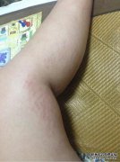 [？妊娠纹什么时候长？]妊娠几个月的妊娠纹