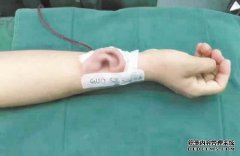 2岁女孩被左耳中部的下一条狗咬伤。剥落受到严