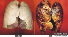 IV期肺癌（早期或晚期）处于什么阶段，您可以期