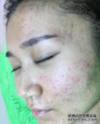 为什么我的脸油腻又容易长粉刺？
