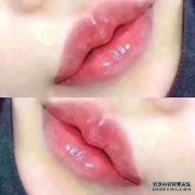 嘴唇如何克服透明质酸？