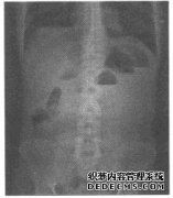 X射线诊断报告：影像学发现：腹部可见多处气液